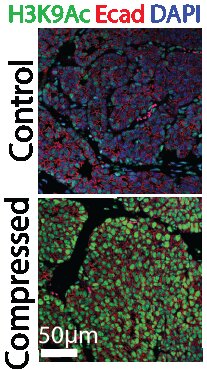 Histone acetylation in control versus compressed mammary cancer cells